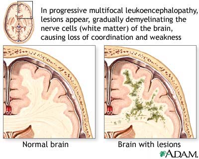 Leukoencephalopathy Leukoencephalopathy