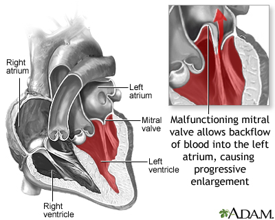 Mitral valve prolapse Mitral valve prolapse