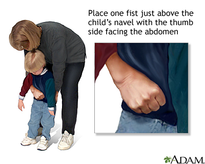 Heimlich maneuver on conscious child