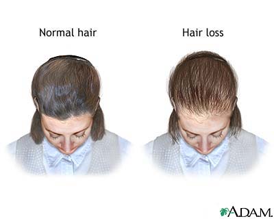 Female-pattern baldness Female-pattern baldness