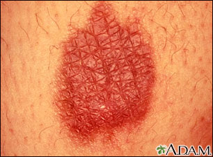 Burn, thermal - close-up Burn, thermal - close-up