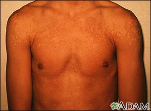 Tinea versicolor - shoulders