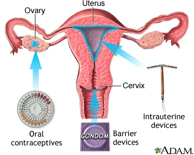 Birth control methods Birth control methods
