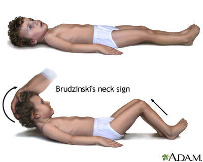 Brudzinski's sign of meningitis Brudzinski's sign of meningitis