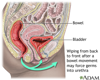 Prevention of cystitis Prevention of cystitis