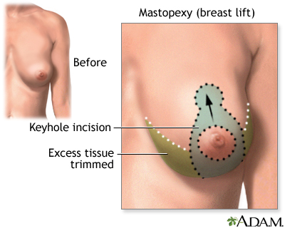 Breast lift (mastopexy) - series - Incisions Breast lift (mastopexy) - series - Incisions