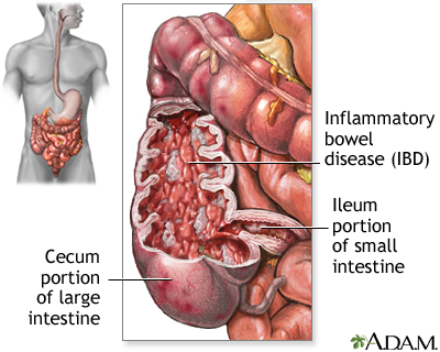 Inflammatory bowel disease Inflammatory bowel disease