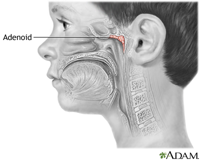 Adenoids Adenoids