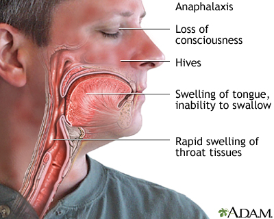 Anaphylaxis Anaphylaxis