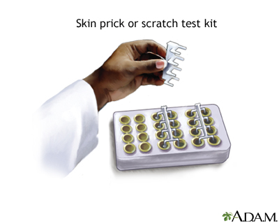 Allergy skin prick or scratch test Allergy skin prick or scratch test