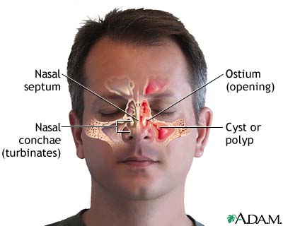 Chronic sinusitis Chronic sinusitis