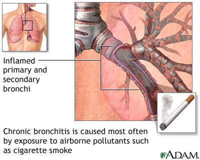 Causes of chronic bronchitis Causes of chronic bronchitis
