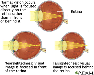 Normal, nearsightedness, and farsightedness Normal, nearsightedness, and farsightedness