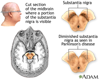 Substantia nigra and Parkinson disease Substantia nigra and Parkinson disease
