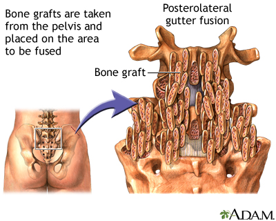 Procedure - Posterolateral gutter fusion Procedure - Posterolateral gutter fusion