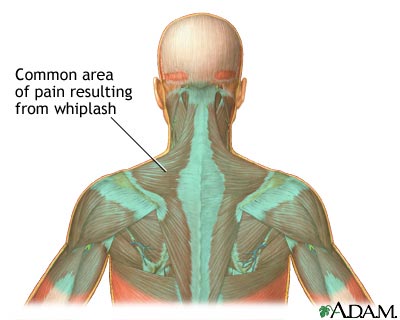 Location of whiplash pain Location of whiplash pain