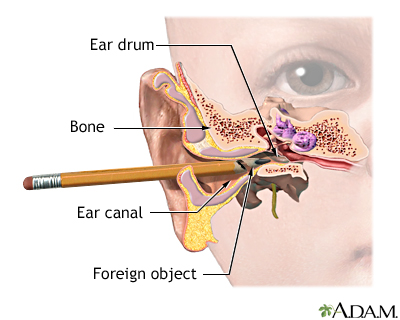 Foreign object in ear Foreign object in ear