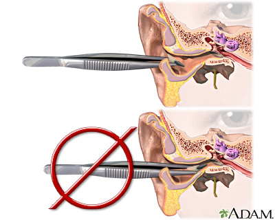 Foreign object removal Foreign object removal