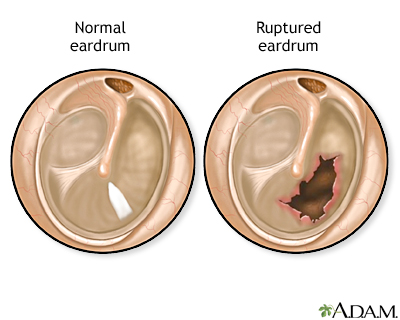 Ruptured eardrum Ruptured eardrum