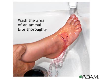 Animal bite - first aid - series Animal bite - first aid - series