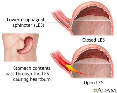 Gastroesophageal reflux disease Gastroesophageal reflux disease