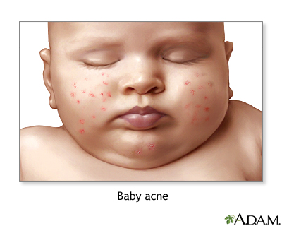 Baby acne Baby acne
