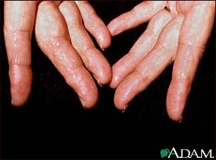 Amyloidosis of the fingers Amyloidosis of the fingers