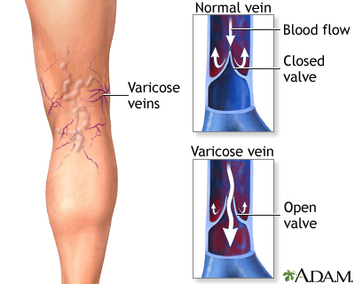 Varicose veins Varicose veins