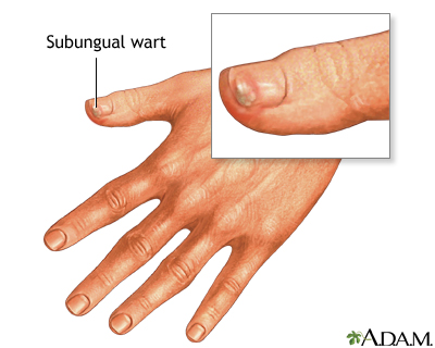 Subungual wart Subungual wart