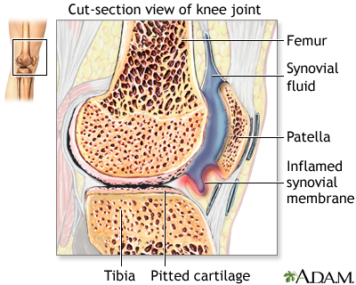 Rheumatoid arthritis Rheumatoid arthritis