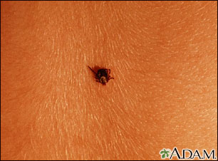 Tick imbedded in the skin Tick imbedded in the skin