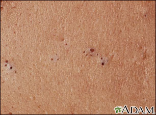 Blackheads (comedones) Blackheads (comedones)