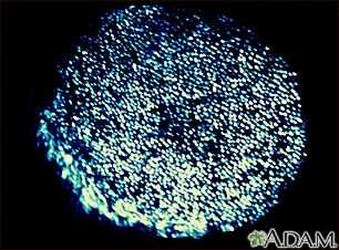 Wood's lamp test - of the scalp Wood's lamp test - of the scalp