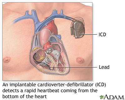 Implantable cardioverter-defibrillator Implantable cardioverter-defibrillator
