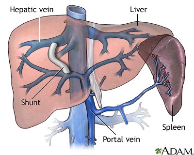 Transjugular intrahepatic portosystemic shunt Transjugular intrahepatic portosystemic shunt