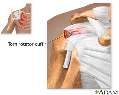 Indications - Torn rotator cuff Indications - Torn rotator cuff