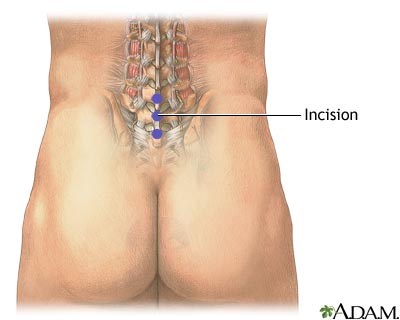 Microdiskectomy - Incision