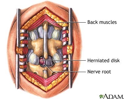 Microdiskectomy - Indications Microdiskectomy - Indications