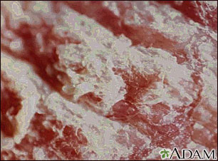 Psoriasis - magnified x4 Psoriasis - magnified x4