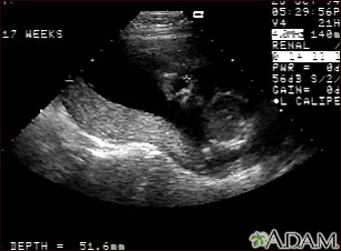 Ultrasound, normal relaxed placenta Ultrasound, normal relaxed placenta