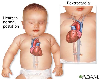 Dextrocardia Dextrocardia