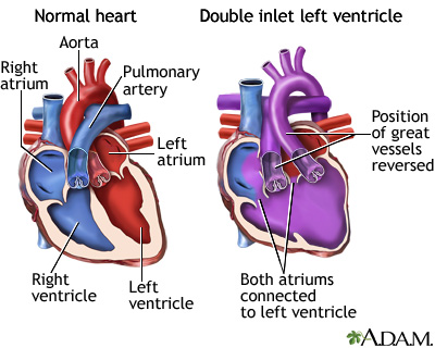 Double inlet left ventricle Double inlet left ventricle