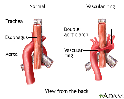 Vascular ring Vascular ring