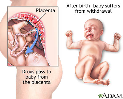 Neonatal abstinence syndrome Neonatal abstinence syndrome