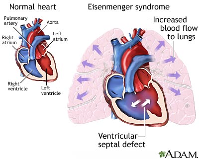 Eisenmenger syndrome (or complex) Eisenmenger syndrome (or complex)