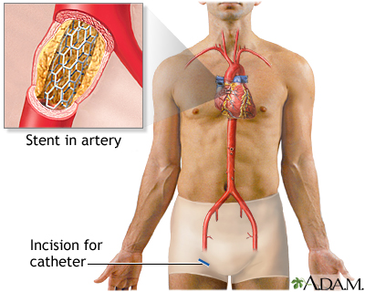 Coronary artery stent Coronary artery stent