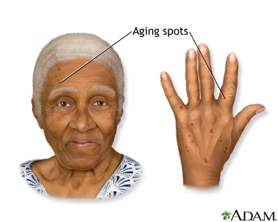 Aging spots Aging spots