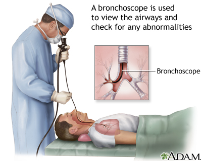Bronchoscopy Bronchoscopy