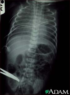 Totally anomalous pulmonary venous return - X-ray