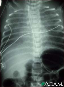 Totally anomalous pulmonary venous return - X-ray